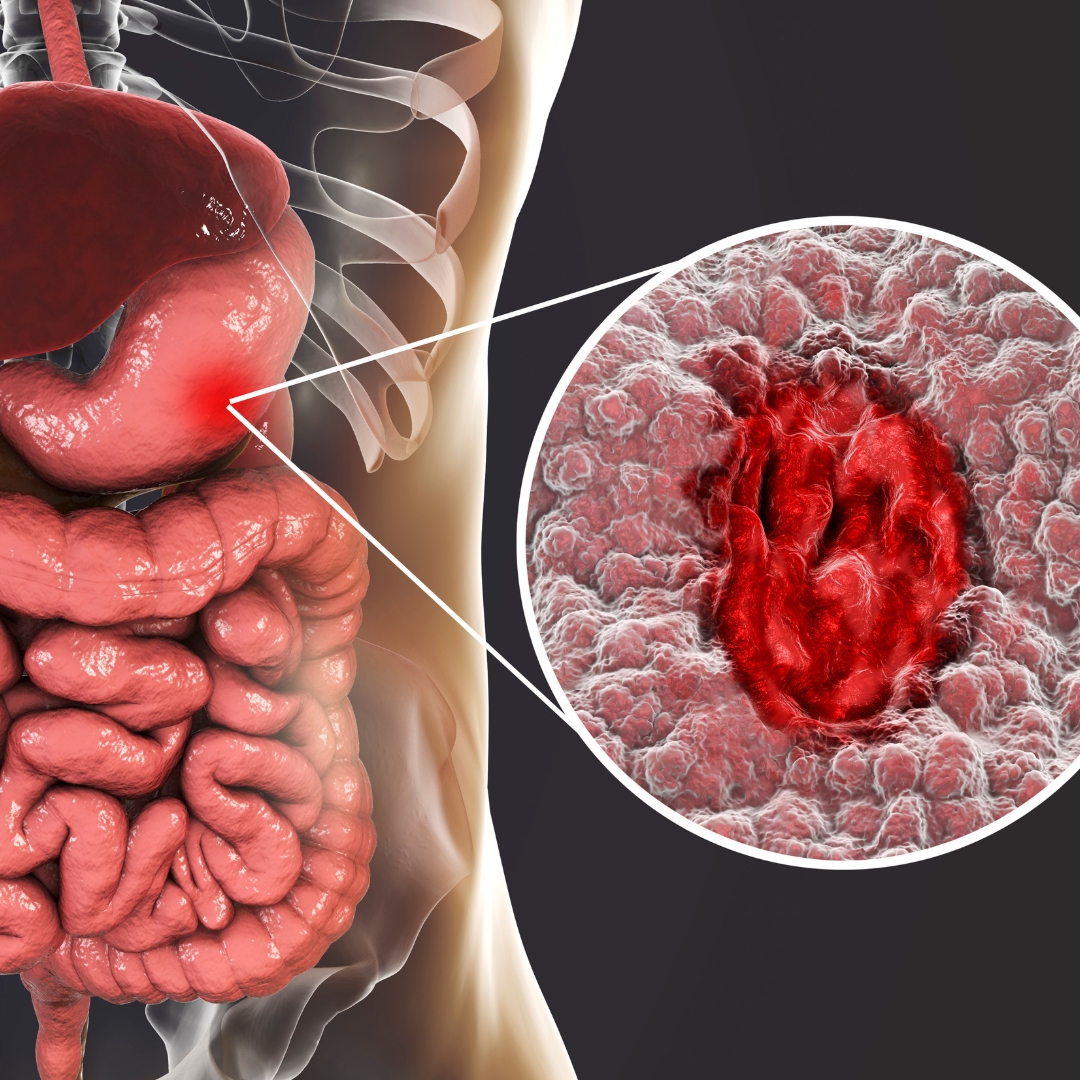 Gastritis