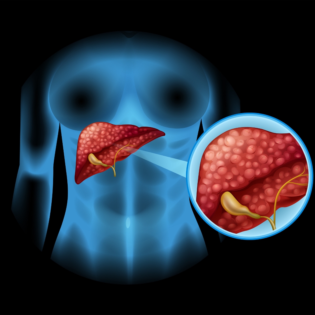 Gastritis