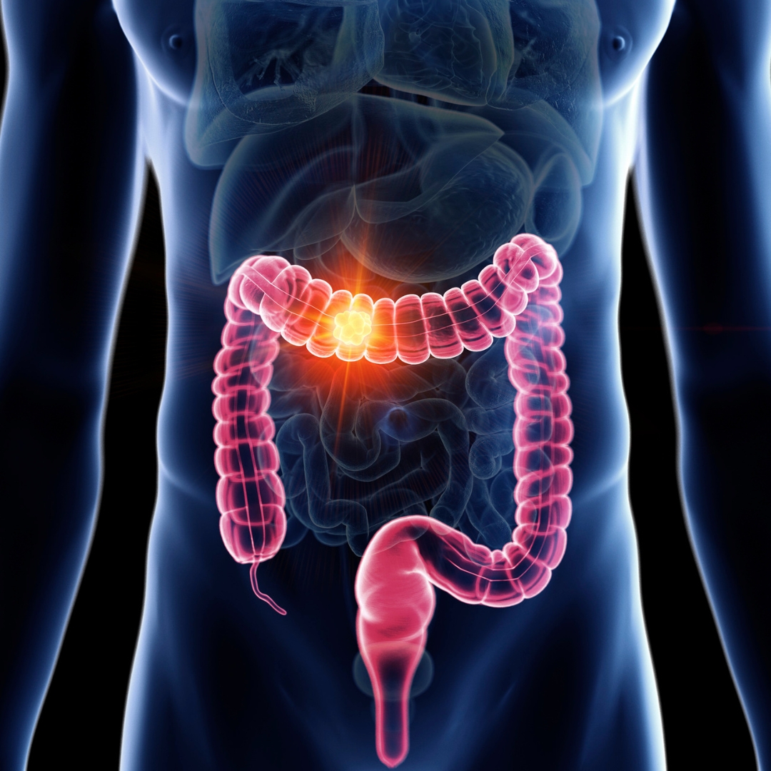Gastritis